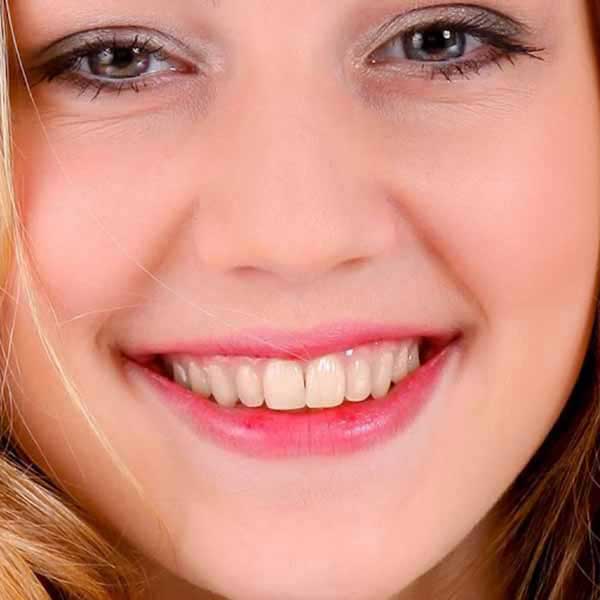 Before Dental Treatment at Vidhaan Dental Clinic