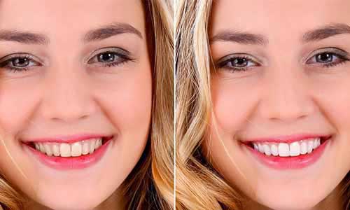 Teeth Whitening in Pune