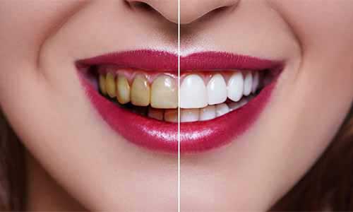 Professional Teeth Whitening in Lohegaon